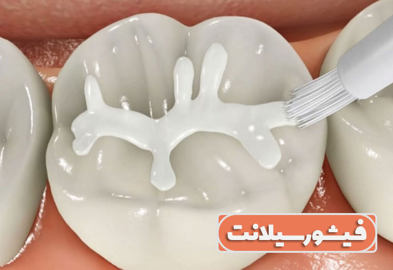 فیشورسیلانت