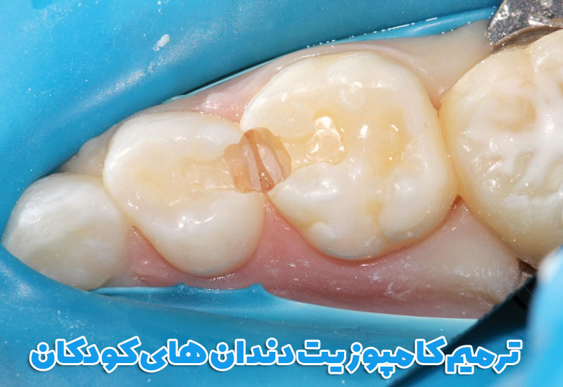 ترمیم کامپوزیت دندان های کودکان