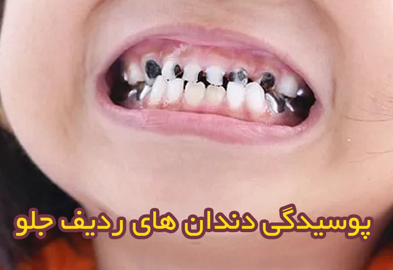 پوسیدگی دندان جلو
