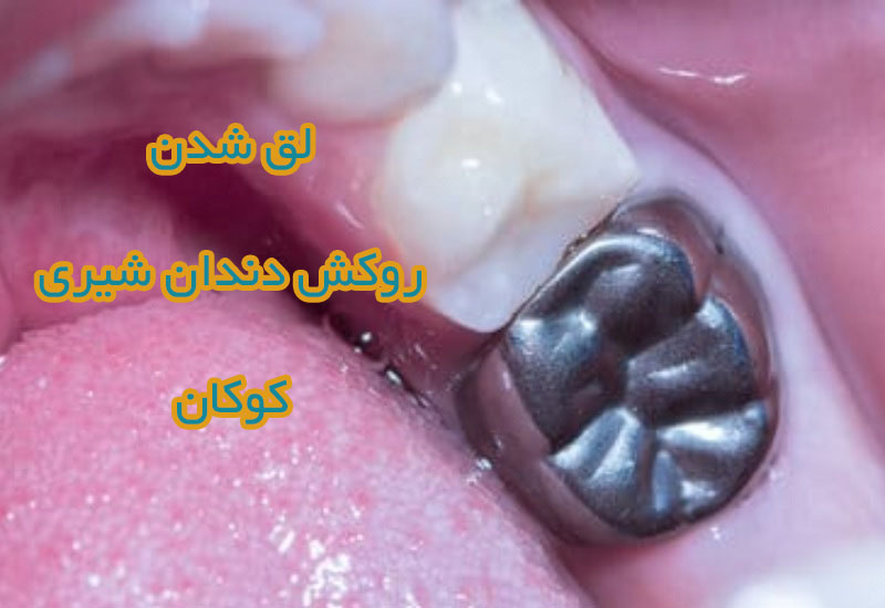 لق شدن روکش دندان شیری کودکان