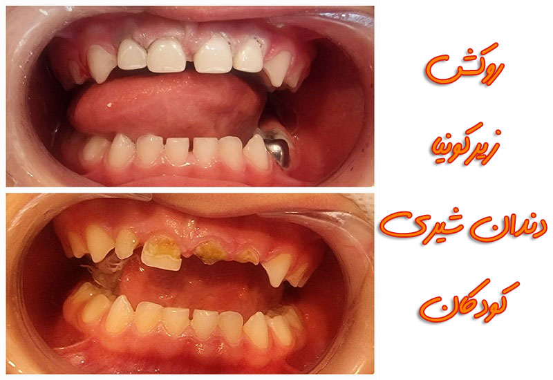 روکش زیرکونیا دندان شیری کودکان