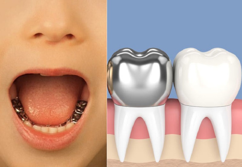 روکش دندان فلزی یا سفید؟