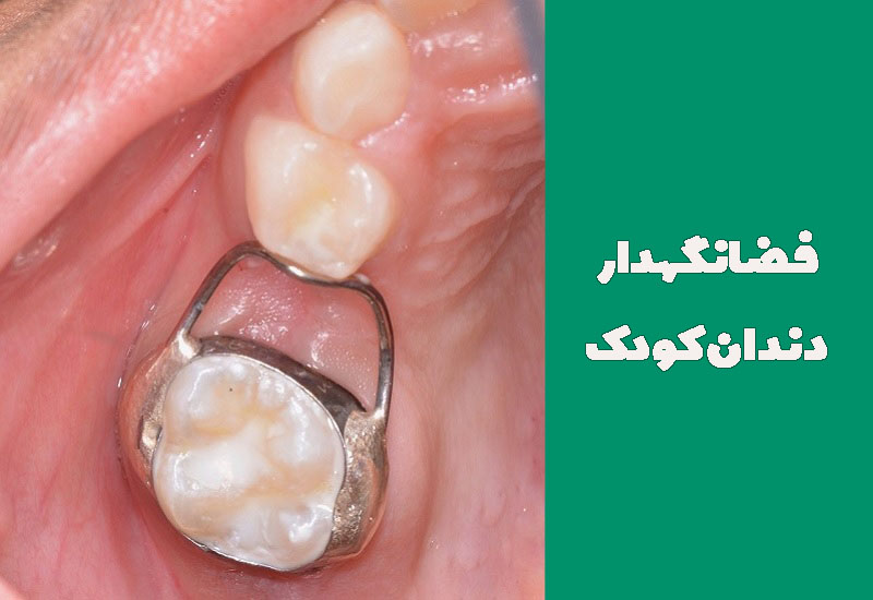فضانگهدار دندان کودک