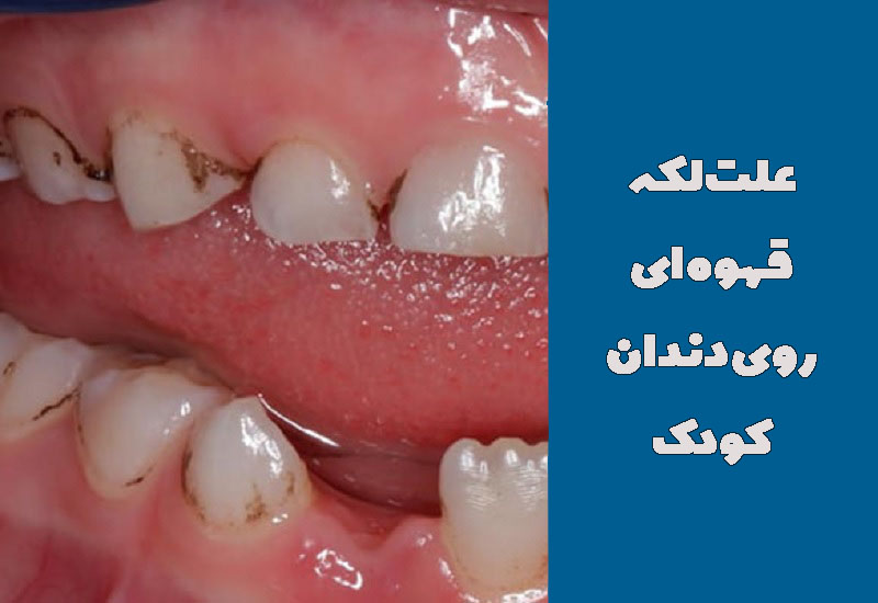لکه قهوه ای روی دندان کودک