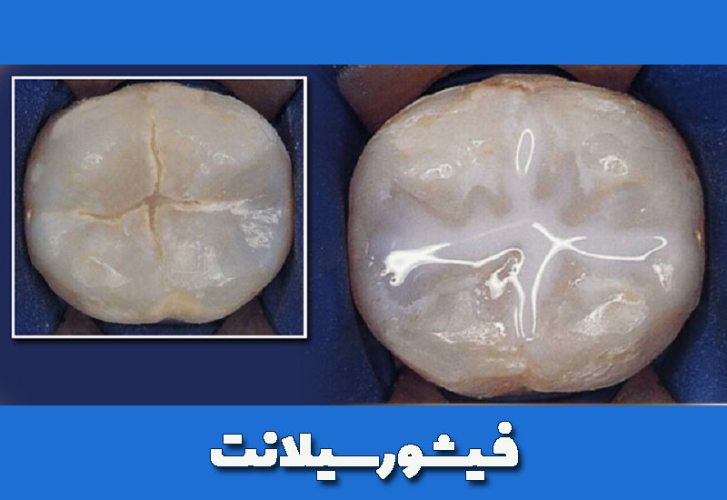 فیشور سیلانت