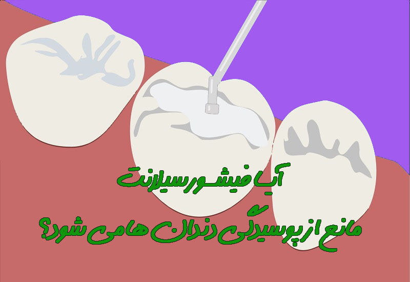 آیا فیشورسیلنت مانع پوسیدگی دندان میشود؟ 3 56465454564654