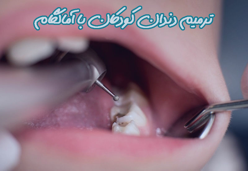 ترمیم پوسیدگی دندان کودکان با آمالگام 1 52456432645fdd